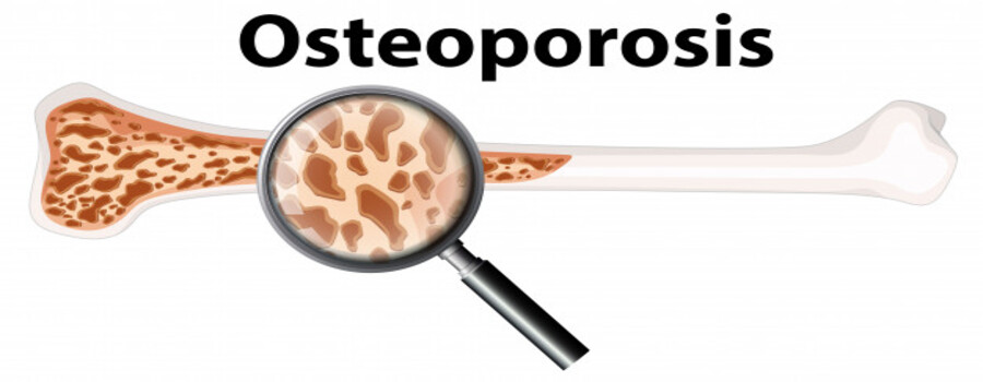 The Most Effective Ways To Treat & Prevern Osteoporosis
