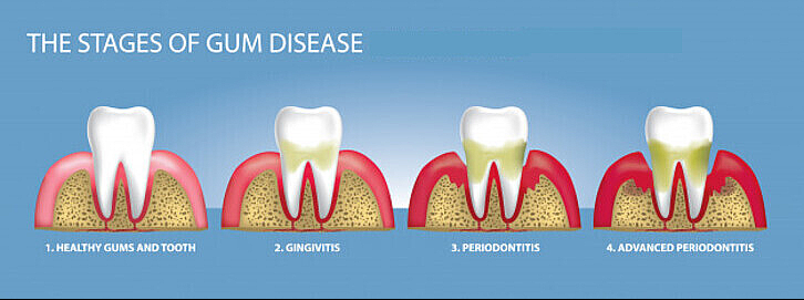 How To Regrow Gums And Restore Jaw Bone Loss